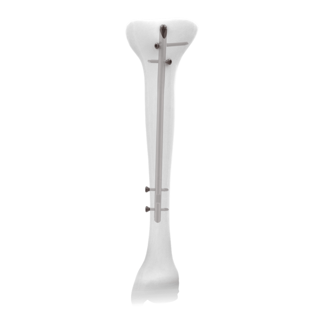 TN-ADVANCED™ - Tibial Nailing System