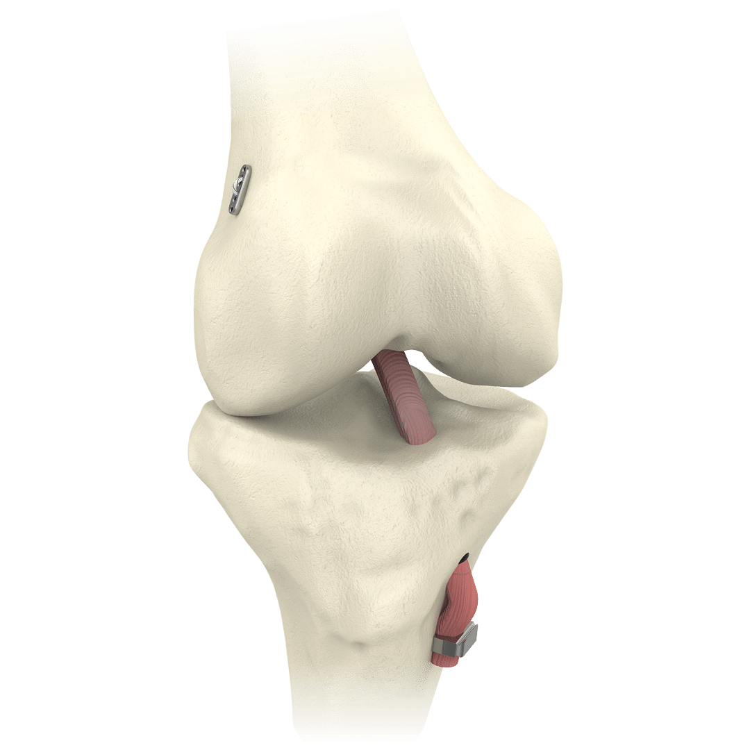 Arthrex - Low Profile Ligament Staples