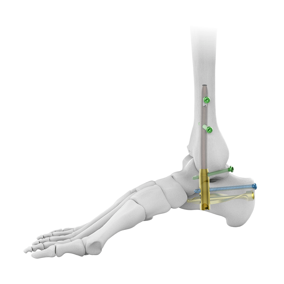 Phantom® Hindfoot TTC/TC System – Paragon 28