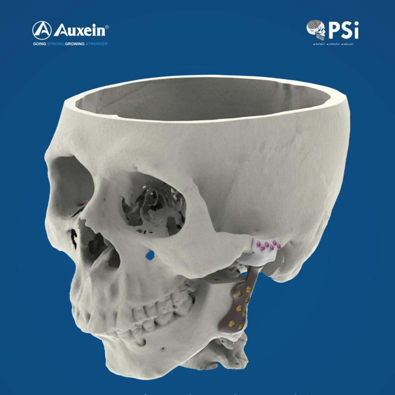 Auxein Medical Unveils Groundbreaking Study on Customized
