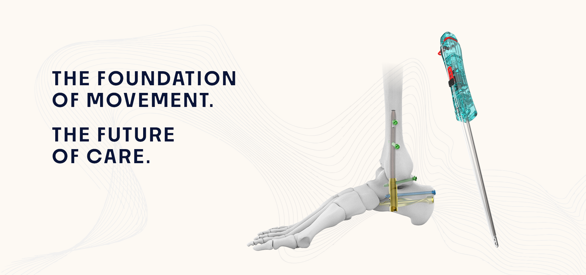 Illustrated foot skeleton with surgical implants and a metallic limb construct, paired with a blue external device, on a pale background with wave patterns.