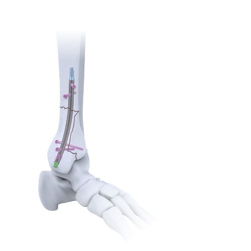 Medical illustration of the lower leg and ankle showing an orthopedic implant (intramedullary rod with screws) stabilizing the tibia.