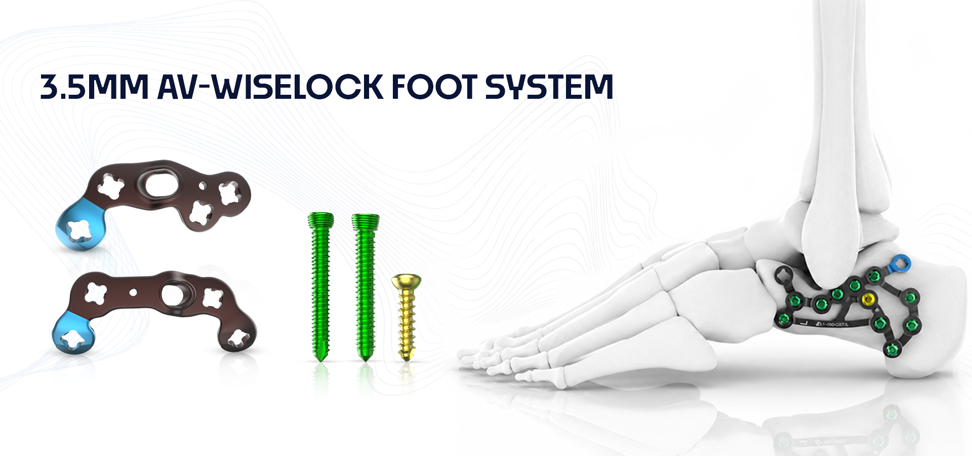 Foot-ankle orthopedic implants: two locking plates with multiple screws and a skeletal foot model with ankle implants