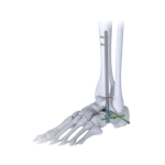 3D rendering of a foot and ankle bones with surgical hardware (screws and plates) stabilizing the tibia/fibula at the ankle.