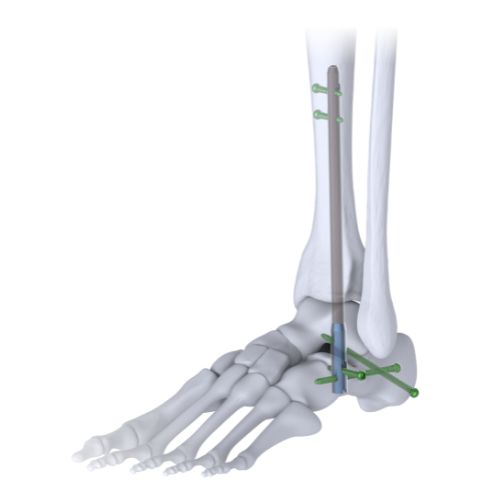 An anatomical foot and ankle model showing orthopedic screws and pins in the ankle and foot bones.