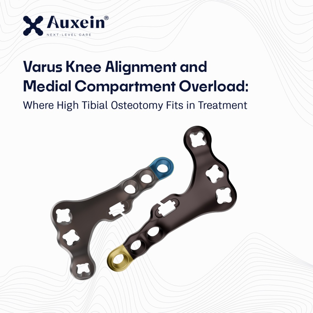 Hero image with two orthopedic knee implants (plates and screws) on a white background, accompanying an article about Varus Knee Alignment and Medial Compartment Overload.