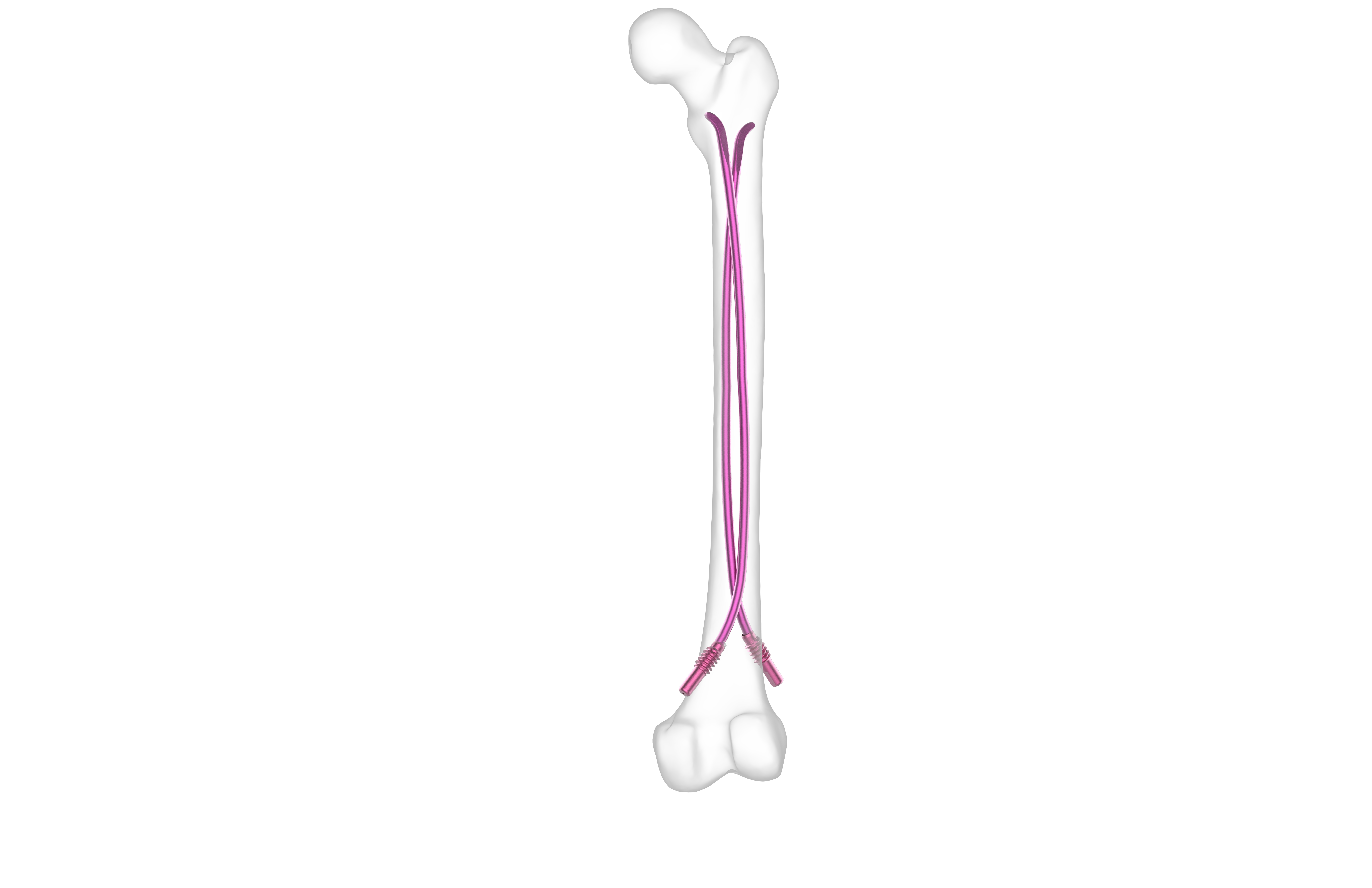 Functional Outcome of Pediatric Subtrochanteric Fractures Treated With a Titanium  Elastic Nailing System (TENS) Versus Plating