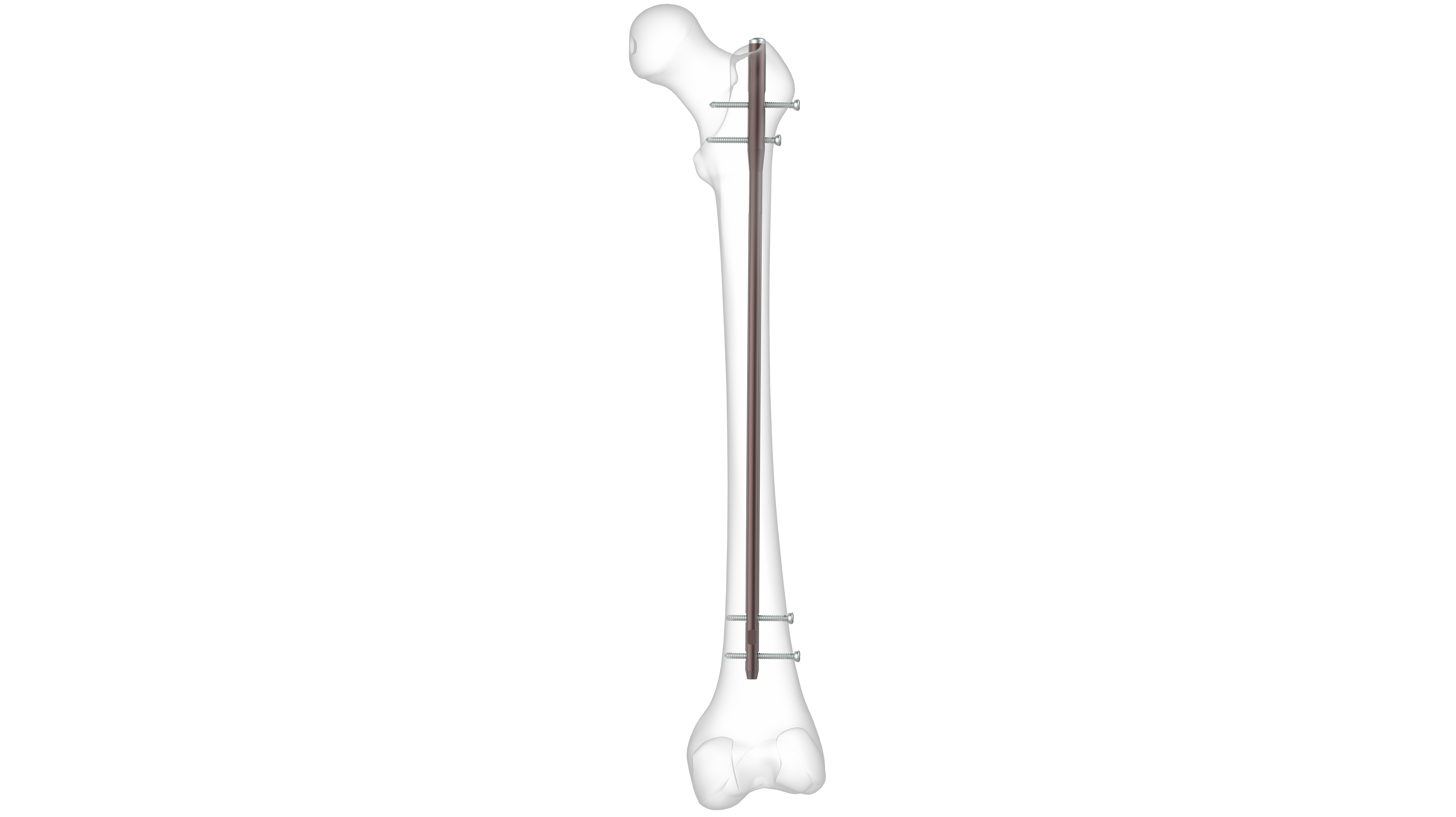 Full article: Tibial lengthening using a retrograde magnetically driven  intramedullary lengthening device in 10 patients with preexisting ankle and  hindfoot fusion