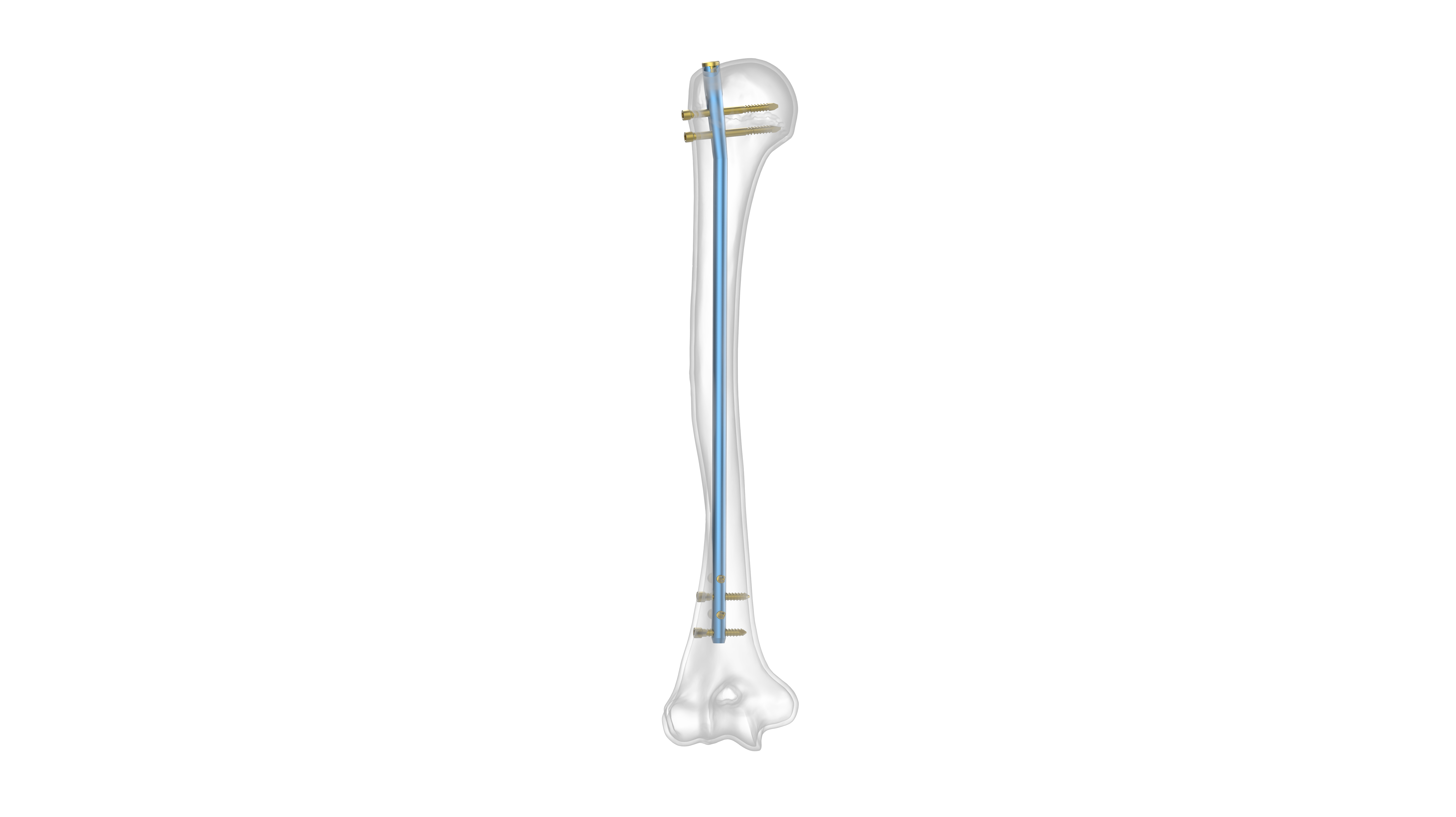 JIN Type Humerus Nailing System - Auxein: Pioneering Orthopedic Solutions  Worldwide
