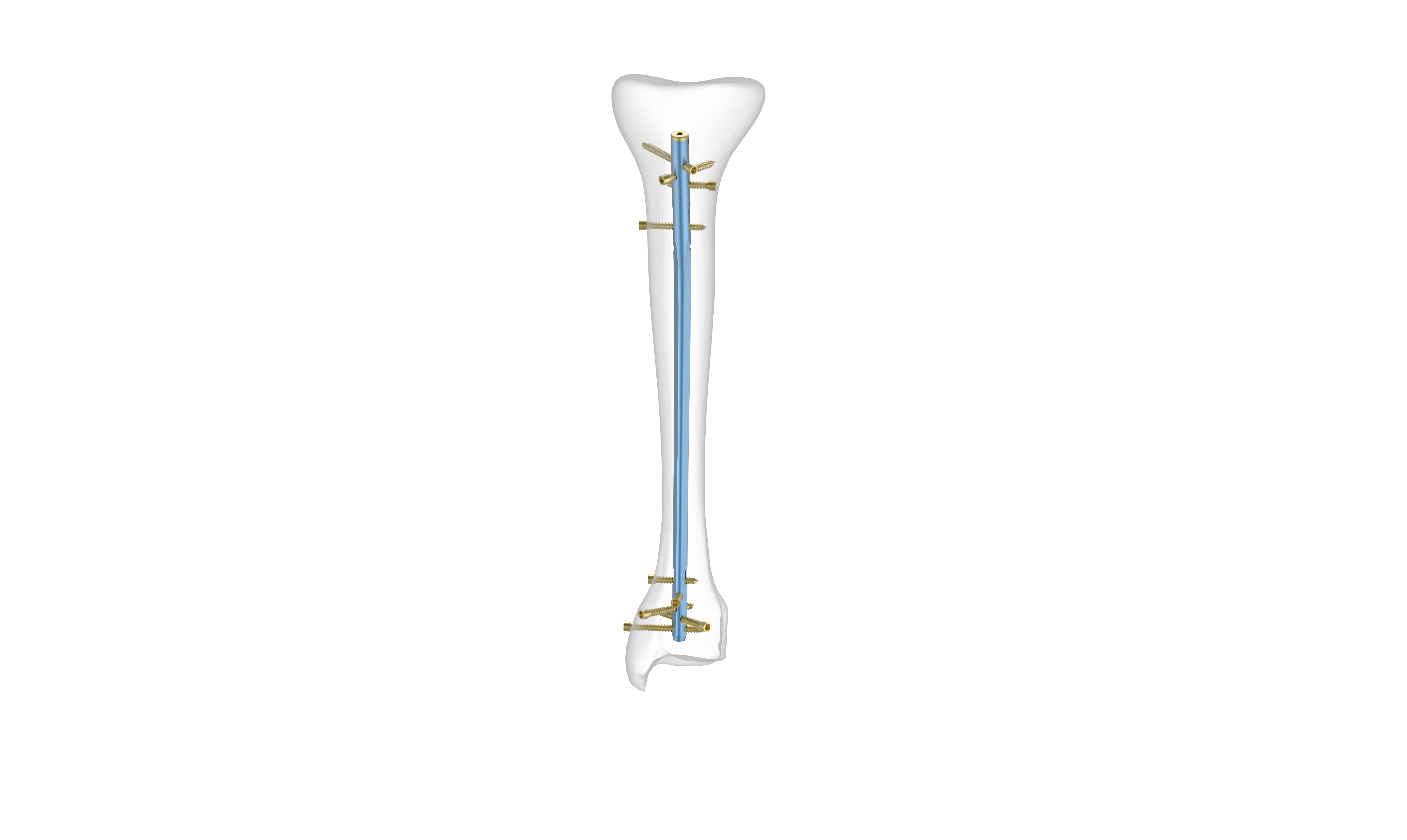 Percutaneous titanium elastic nail for femoral shaft fracture in patient  between 5 and 15 years - ScienceDirect