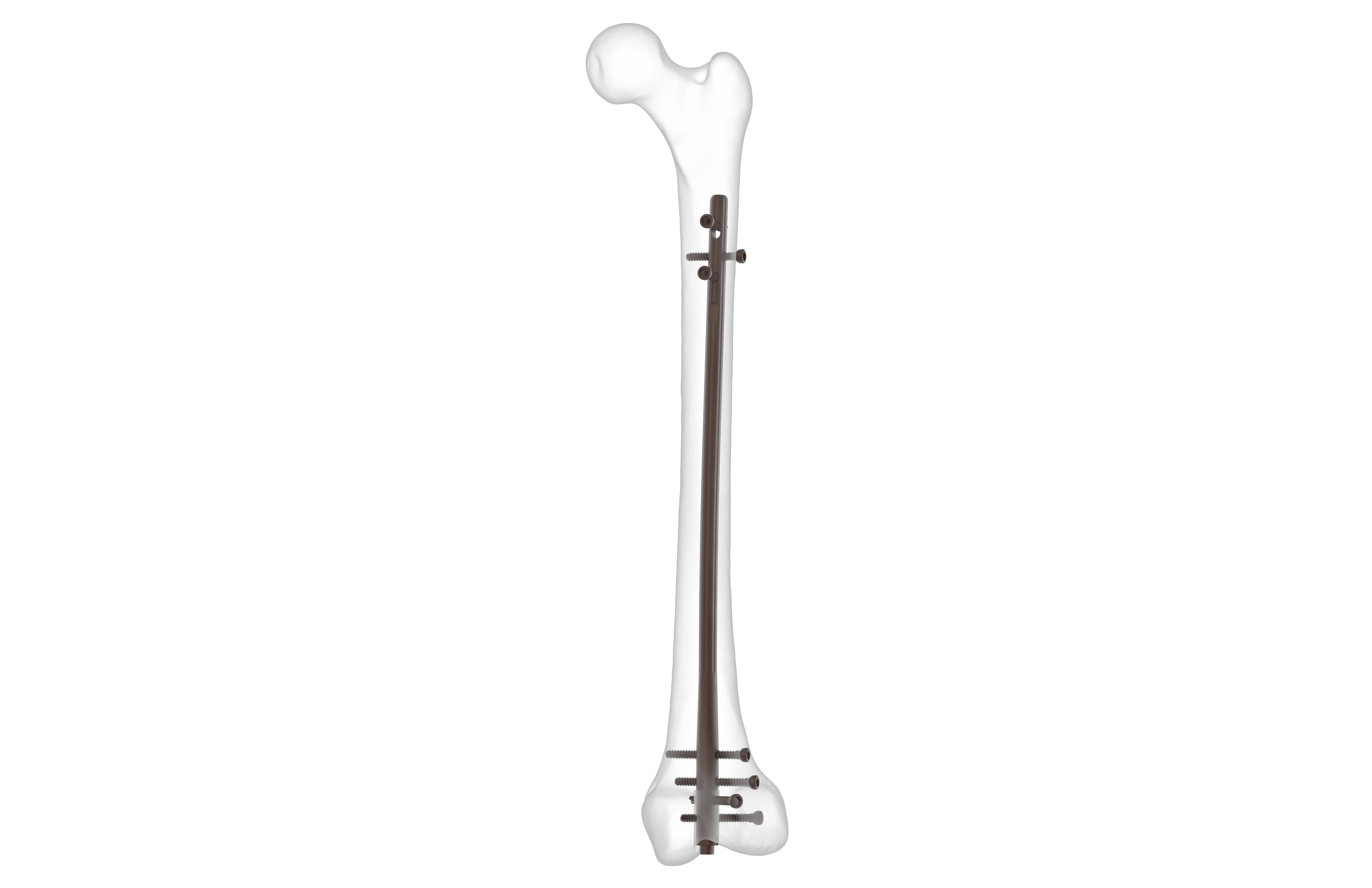 DFN Distal Femoral Nail II,Medical Device Manufacturers -Double Medical